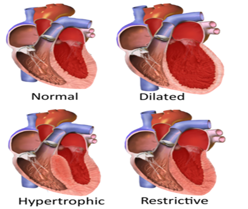 Different-forms-of-cardiomyopathy